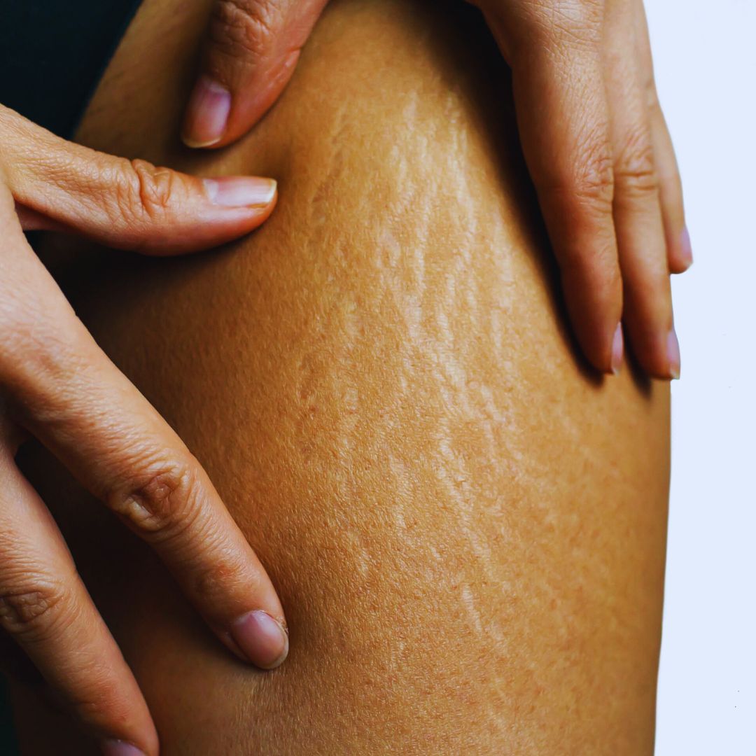 Treat cellulite, scars and more with microchanneling.