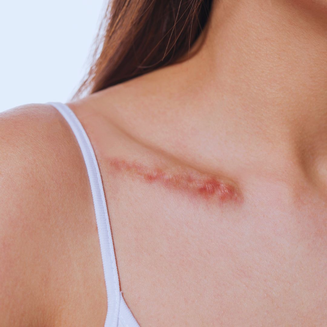 A women with a scar on her shoulder.